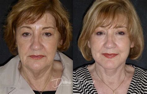 Annette 63 55 64 Brow Eyelid Surgery Eyes Face And Necklift Jowls