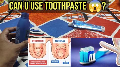 भूल कर भी टूथपेस्ट का इस्तेमाल फाइमोसिस के लिए न करें Phimosis Treatment Foreskin