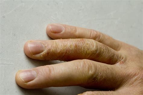 Closeup Of Eczema Dermatitis On Man Hand And Fingers Skin Peeling