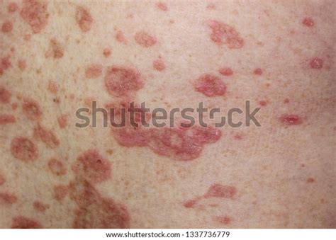 Case Annular Lichen Planus FemaleArkivfotografi1337736779 Shutterstock