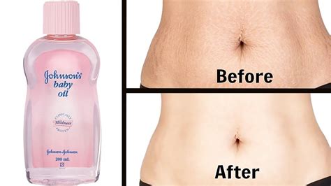 In 5 Days Remove Stretch Marks Completely World S Best Remedy For