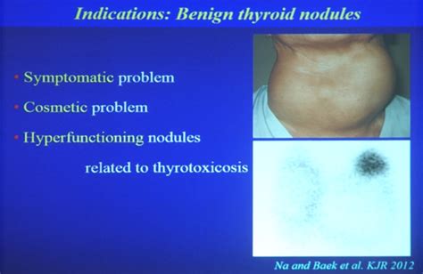 Thyroid Rfa Indications And Evidences
