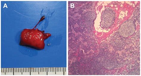 Accurate Diagnosis Of Axillary Lymph Node Metastasis Using Contrast
