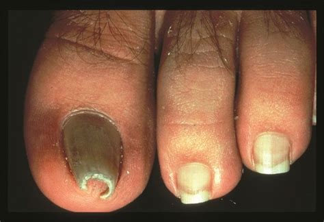 Under The Microscope Pincer Nails Nail Disorders Acrylic Toe Nails