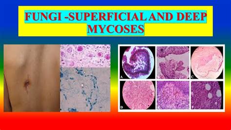 Unit Microbiology Superficial And Subcutaneous Fungal Infections Hot Sex Picture