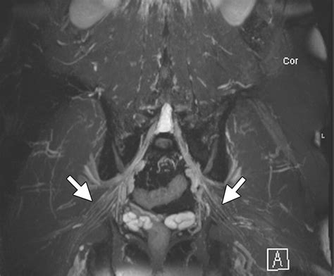 High Resolution 3 T Mr Neurography Of The Lumbosacral Plexus