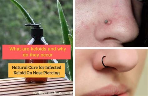 How Do I Get Rid Of A Keloid On My Nose Piercing Naturally Mastery Wiki