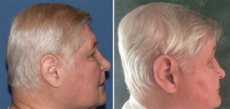 Clinic Snapshots Large Custom Skull Implant For Flat Back Of The Head