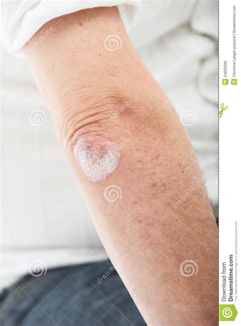 Psoriasis Skin Or Deciding On The Elbow Royalty Free Stock Images