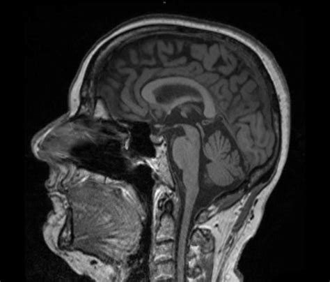 An Mri Showing The Midsagittal Section Of The Brain The Cerebral