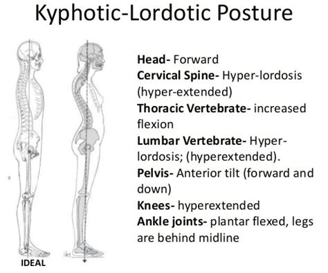 Posture Spotlight Kyphosis Lordosis