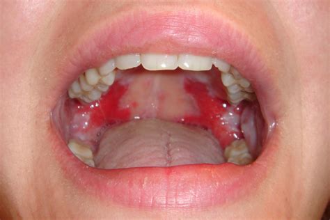 What Causes A Rash On The Roof Of Your Mouth