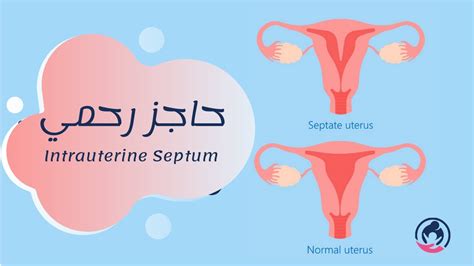 Intrauterine Septum Septate Uterus حاجز رحمي YouTube