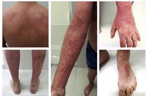 Eczematous Eruption After Guselkumab Treatment For Psoriasis Jaad
