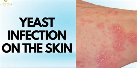 Yeast Infection On The Skin Complete Guide Here