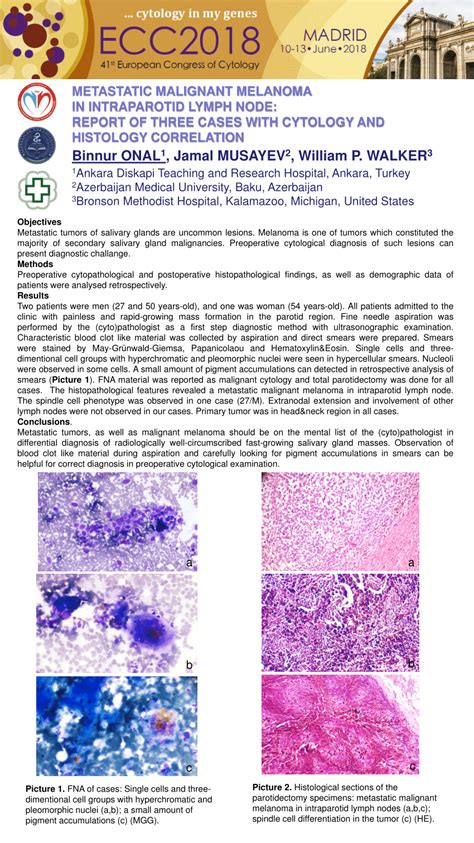 Pdf Metastatic Malignant Melanoma In Intraparotid Lymph Node Report