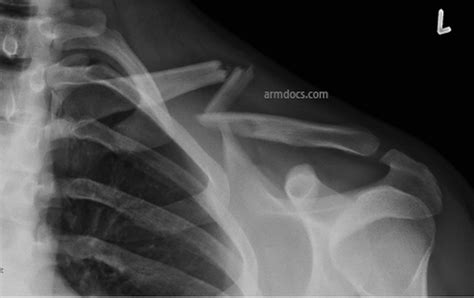 Clavicle Fracture Plate Fixation Arm Docs