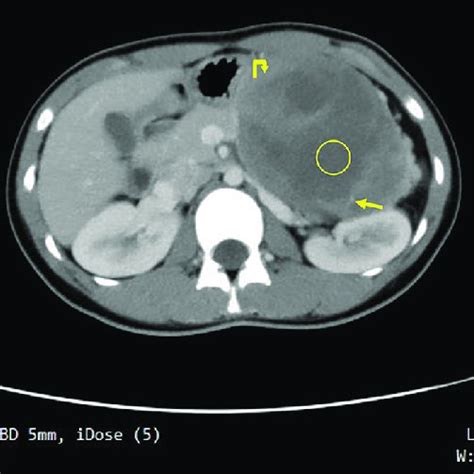 Abdominal Computed Tomography Ct Scan Showing A Large Heterogeneous