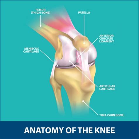 Patellar Fracture Florida Orthopaedic Institute