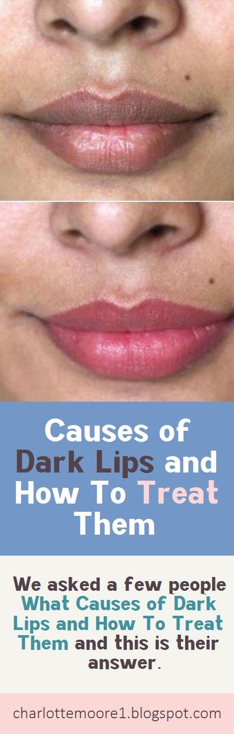 Causes Of Dark Lips And How To Treat Them Charlotte Moore