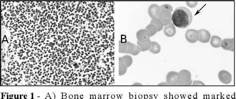 Figure 1 From Waldenströms Macroglobulinaemia Complicated By Pure Red