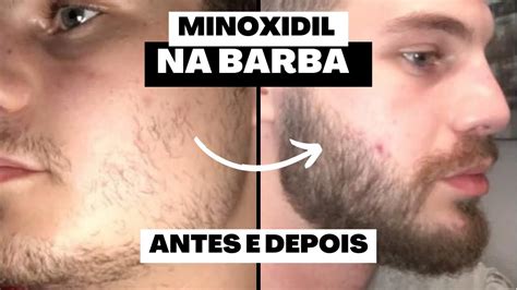 🔴 Minoxidil Antes E Depois Dos Inscritos Barba 2022 Alex Cursino Youtube