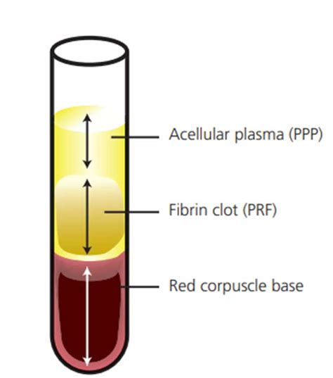 Platelet Rich Fibrin Prf In Periodontics Biologic Off