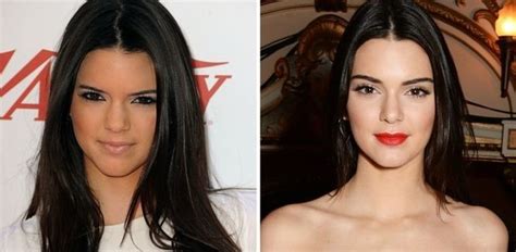 Kendall Jenner Also Uses Plastic Surgery Like Her Sisters