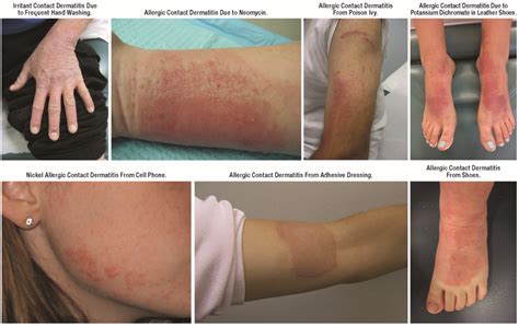 Jcm Special Issue Epidemiology And Treatment Of Atopic Eczema