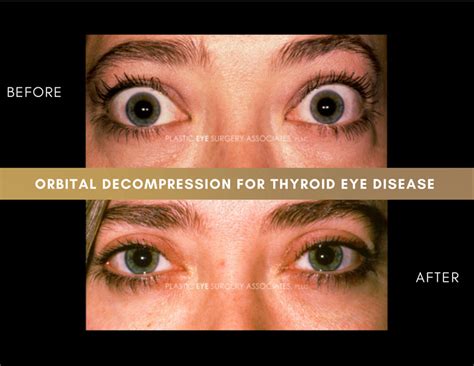 Thyroid Eye Disease Photos Plastic Eye Surgery Associates