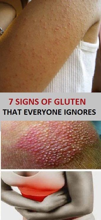 7 Signs Of Gluten Intolerance Everyone Ignores Signs Of Gluten