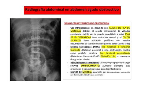 Radiograf A Abdominal En Un Abdomen Agudo Obstructivo Rafael Fernando Lajmanovich Udocz