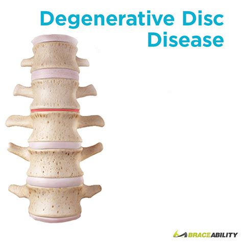 Degenerative Disc Disease Treatment Braceability