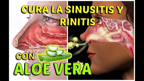 CÓmo Curar La Sinusitis Y Rinitis AlÉrgica Con Aloe Vera Lifestyle