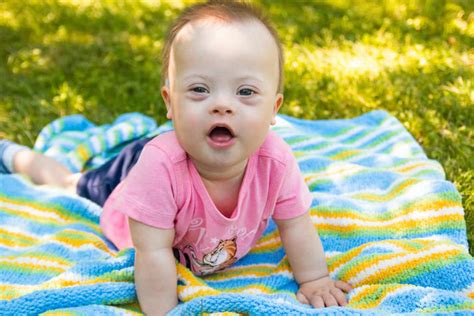 Portrait Of Baby With Down Syndrome On Grass Decision Magazine