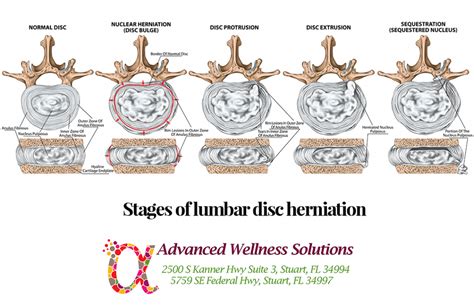 Chiropractic Treatment For Disc Herniation Advanced Wellness Solutions
