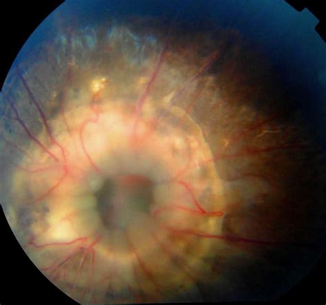 Rare Bilateral Presentation Of Morning Glory Disc Anomaly Bmj Case Reports