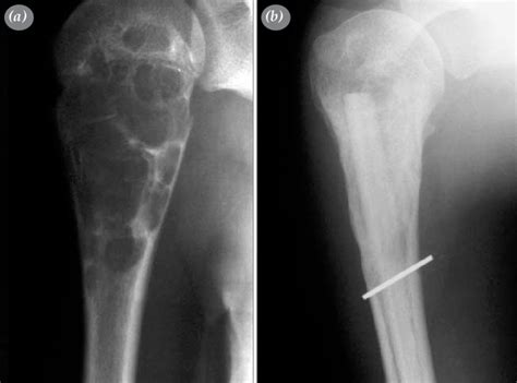 A Pre Operative And B Long Term Post Operative X Rays Of The