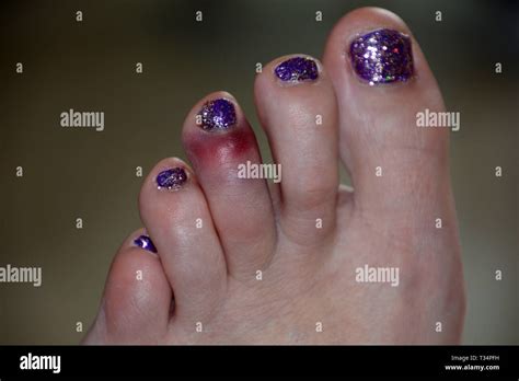 Swollen Foot High Resolution Stock Photography And Images Alamy