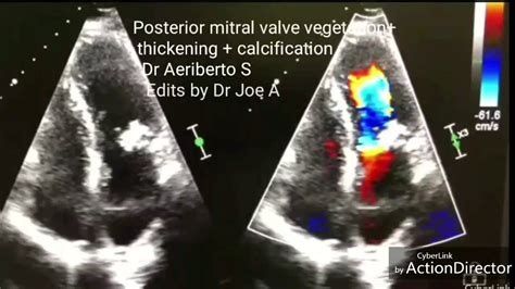 Posterior Mitral Valve Leaflet Thickening With Calcification
