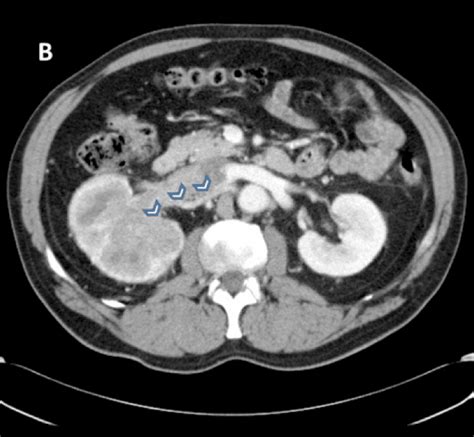 Vascular Extension From An Infiltrating Renal Tumor Ukidneys