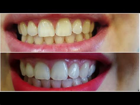 Sistema de blanqueamiento en casa. Blanqueamiento Dental en Casa! // Rocío Soriano // - YouTube