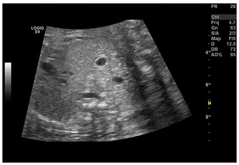 Ultrasound And Differential Diagnosis Of Fetal Abdominal Cysts