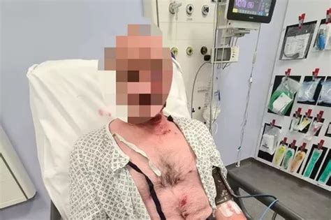 Man Loses Two Fingers After Firework Explodes In His Hand