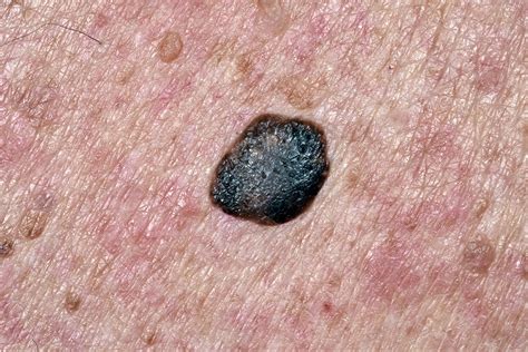 Seborrheic Keratosis Dermatoscope