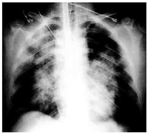Acute Pulmonary Part 1