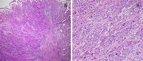 Variants Of Gastric Carcinoma Morphologic And Theranostic Importance