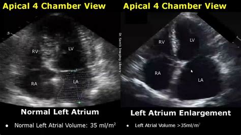 Echocardiography Normal Vs Abnormal Images Heart Ultrasound Cardiac