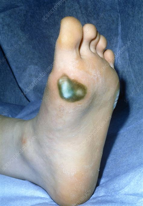 Blackening Of Skin Due To Gangrene On Foot Stock Image M1650182