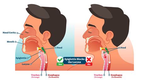 Throat Swallowing And Voice Disorders Annapolis And Severna Park Md